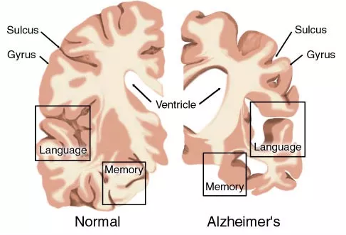 AD药物研发现状：辉瑞、礼来、百健、诺华、强生……