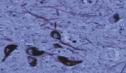 正常人：黑质神经元存在