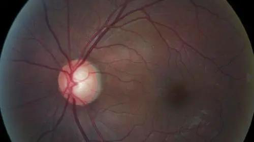 青光眼的克星来袭，助力患者远离视力的“窃贼”